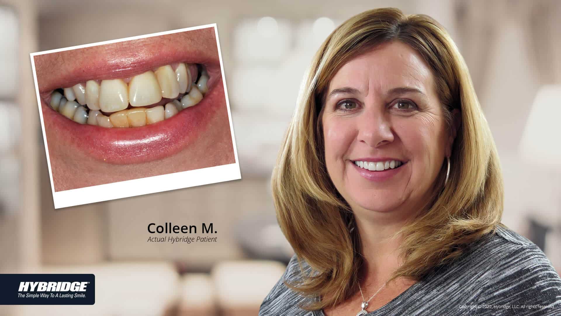 before-after_smile_gallery_w-bkgds_colleen-m_1920x1080_3