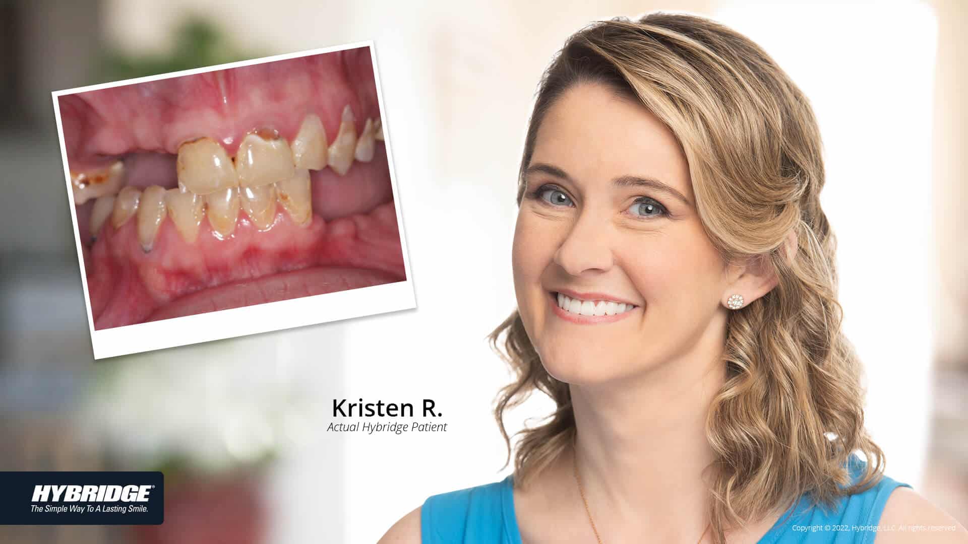 before-after_smile_gallery_w-bkgds_kristen-r_1920x1080