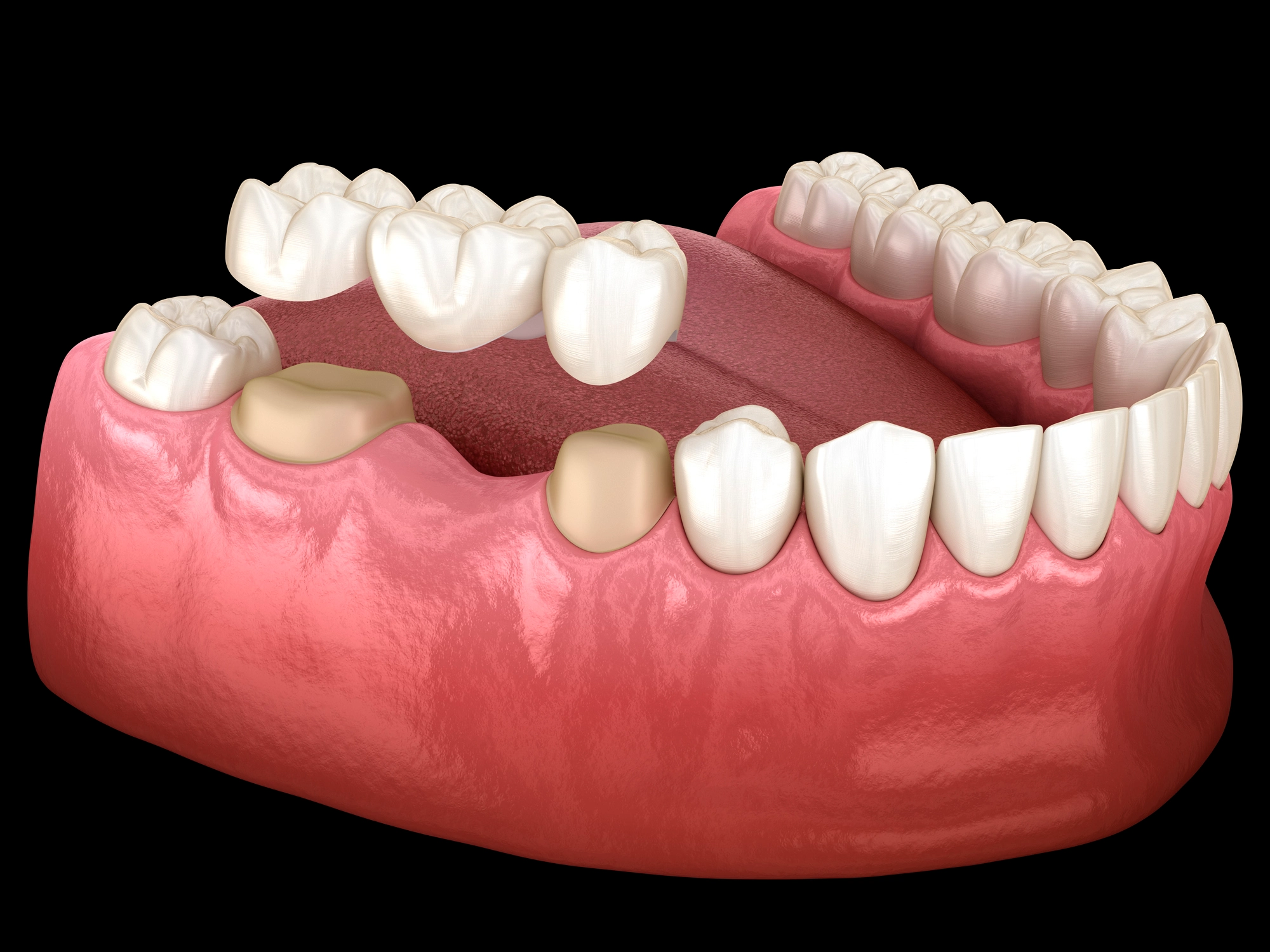 how to take care of dental bridges